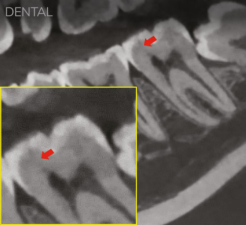 dental-vs-endo-before