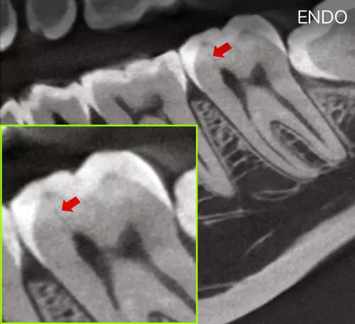 dental-vs-endo-after